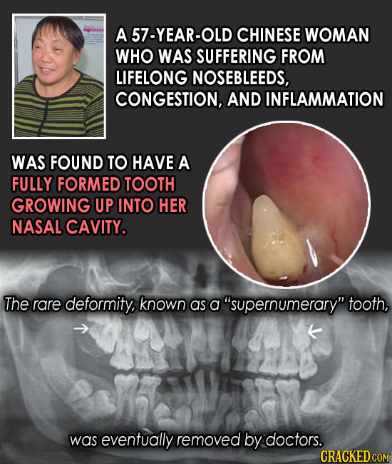 A 57-YEAR-OLD CHINESE WOMAN WHO WAS SUFFERING FROM LIFELONG NOSEBLEEDS, CONGESTION, AND INFLAMMATION WAS FOUND TO HAVE A FULLY FORMED TOOTH GROWING UP