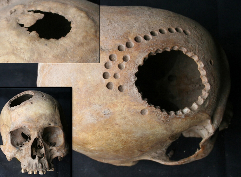 Trepanation in South-Central Peru during the early late intermediate period