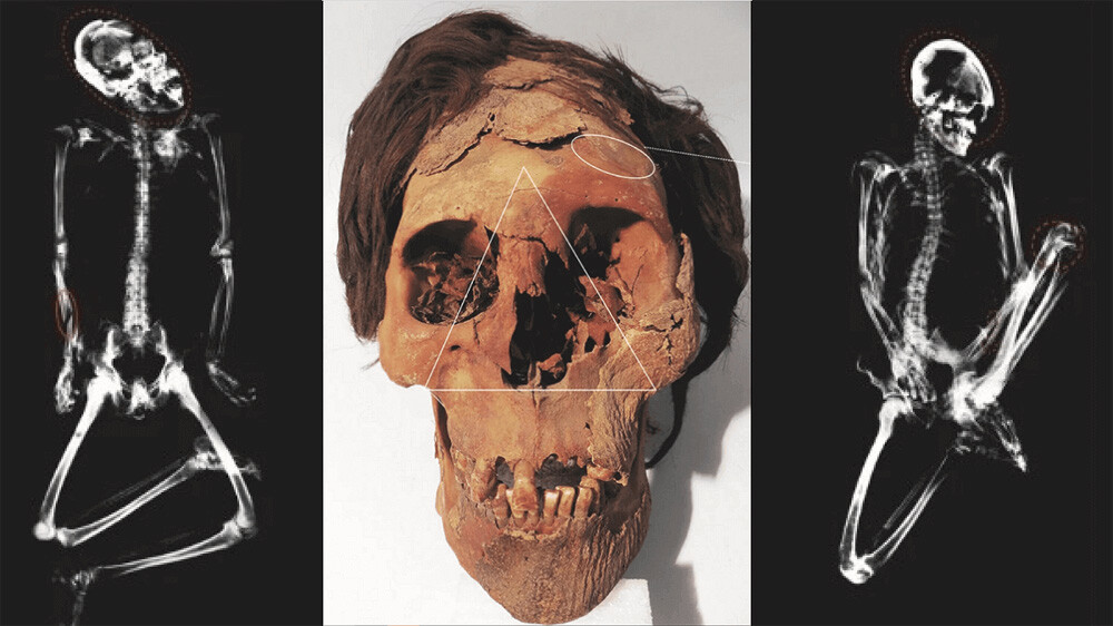 Skeletons and marks of lethal trauma to the face. (Standen et al., JAA, 2021)