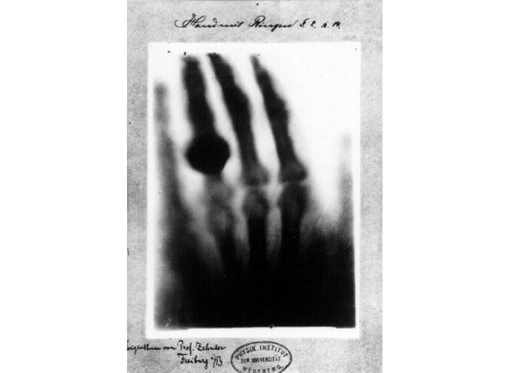 Wilhelm Röntgen's first "medical" X-ray, of his wife's hand