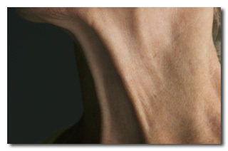 What Obamacare Means to the Jerk Who Stole My Girlfriend