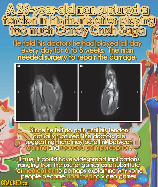 29eyearold man ruptured a tendon in his thumb after playing too much Candy Crush Saga He told his doctors he had played all day every day for 6 to 8 w