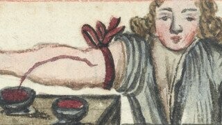 Lovesick in the Middle Ages? A Doctor Might Slice You Open