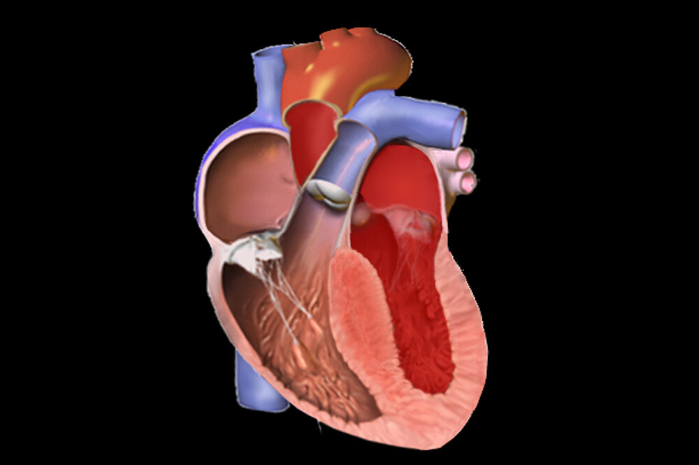 Illustration of asymmetric septal hypertorphy in HCM