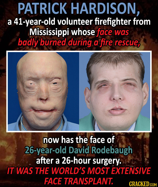 PATRICK HARDISON, a 41-year-old volunteer firefighter from Mississippi whose face was badly burned during a fire rescue, now has the face of 26-year-o