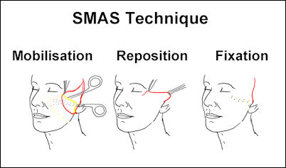 SMAS Technique Mobilisation Reposition Fixation