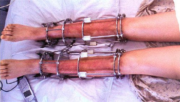 Reddit leg lengthening surgery Leg lengthening