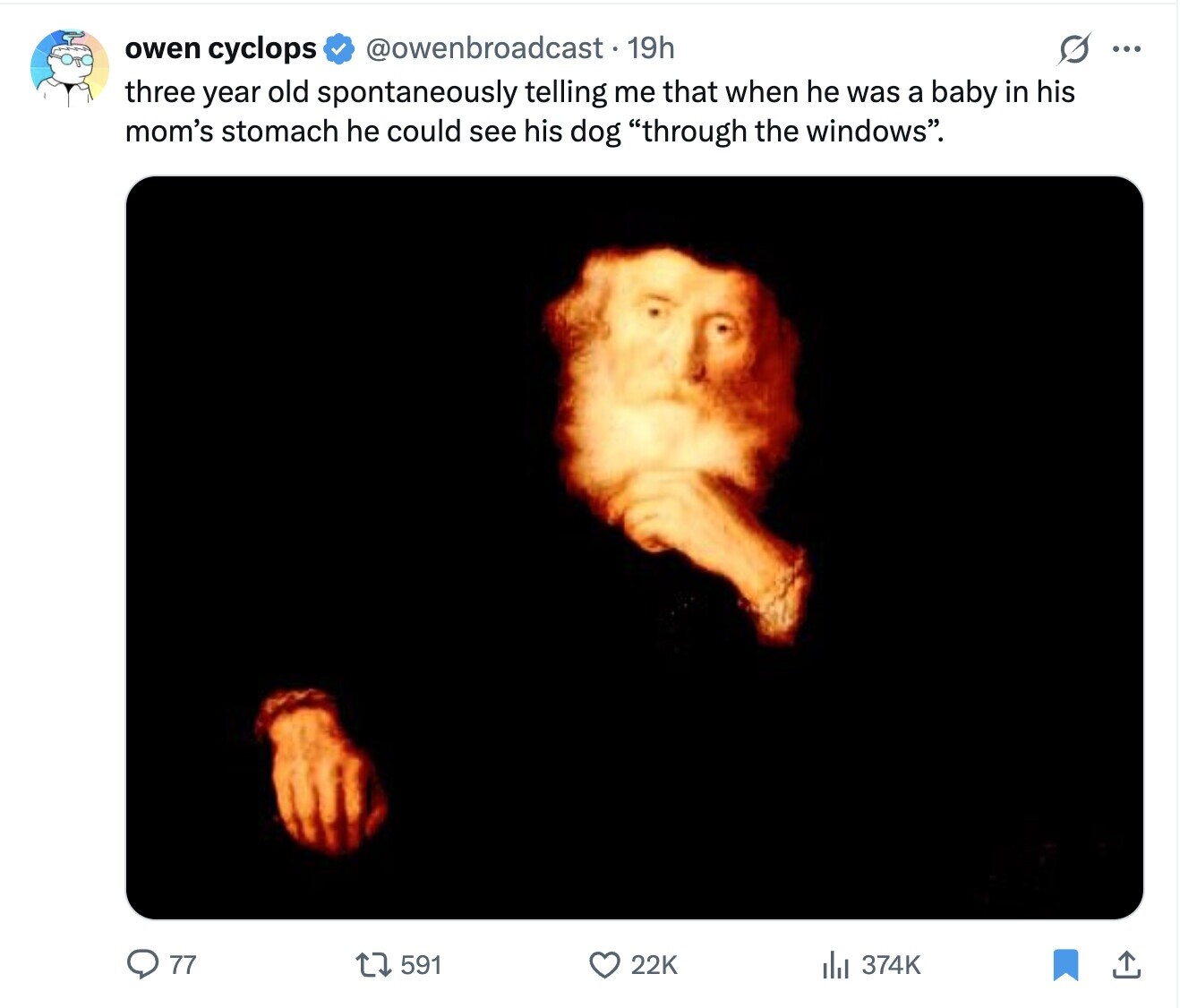 @owenbroadcast. 19h O ... owen cyclops three year old spontaneously telling me that when he was a baby in his mom's stomach he could see his dog through the windows. 77 591 22K 374K