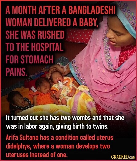 A MONTH AFTER A BANGLADESHI WOMAN DELIVERED A BABY, SHE WAS RUSHED TO THE HOSPITAL FOR STOMACH PAINS. It turned out she has two wombs and that she was in labor again, giving birth to twins. Arifa Sultana has a condition called uterus didelphys, where a woman develops two uteruses instead of one. CRACKED.COM