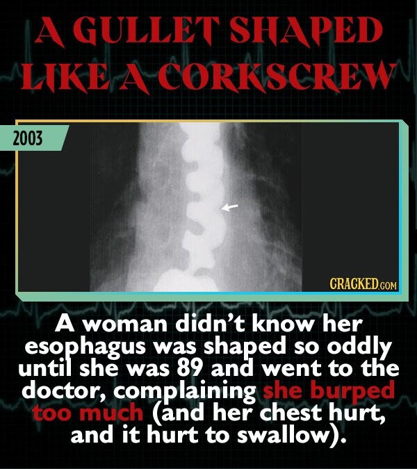 A GULLET SHAPED LIKE A CORKSCREW 2003 A woman didn't know her esophagus was shaped so oddly untill she was 89 and went to the doctor, complaining she burped too much (and her chest hurt, and it hurt to swallow).