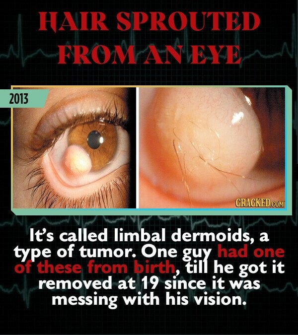 HAIR SPROUTED FROM AN EYE 2013 CRACKED COM It's called limbal dermoids, a type of tumor. One guy had one of these from birth till he got it removed at 19 since it was messing with his vision.