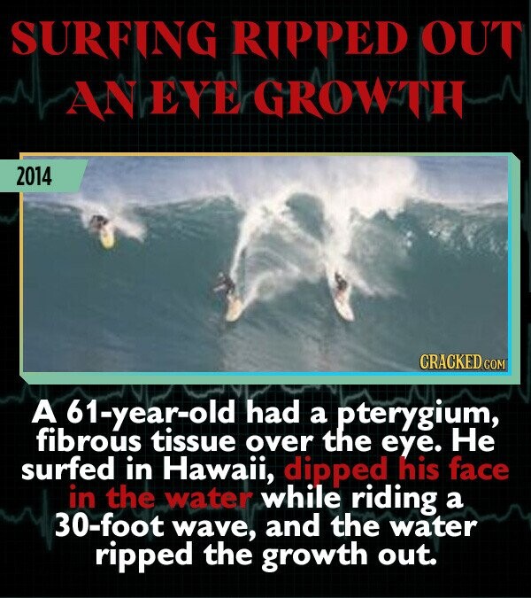 SURFING RIPPED OUT AN EYE GROWTH 2014 CRACKED COM A 61-year-old had a pterygium, fibrous tissue over the eye. He surfed in Hawaii, dipped his face in the water while riding a 30-foot wave, and the water ripped the growth out.