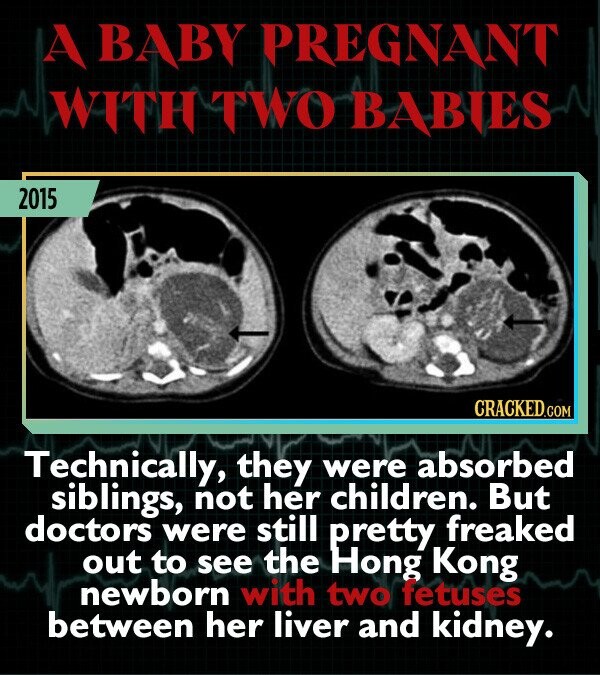 A BABY PREGNANT WITH TWO BABIES 2015 CRACKED.cO COM Technically, they were absorbed siblings, not her children. But doctors were still pretty. freaked out to see the Hong Kong newborn with two fetuses between her liver and kidney.