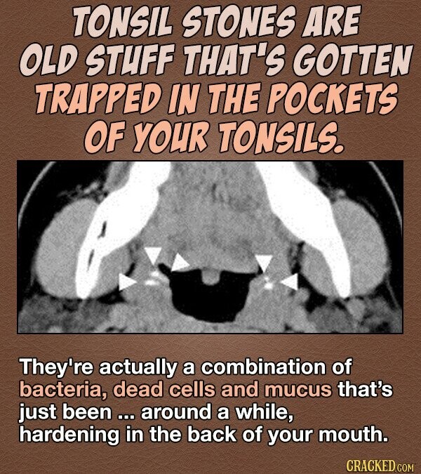 TONSIL STONES ARE OLD STUFF THAT'S GOTTEN TRAPPED IN THE POCKETS OF YOUR TONSILS. They're actually a combination of bacteria, dead cells and mucus that's just been ... around a while, hardening in the back of your mouth. CRACKED COM