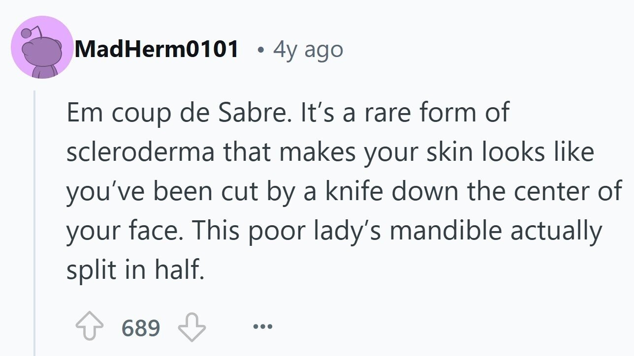 MadHerm0101 e 4y ago Em coup de Sabre. It's a rare form of scleroderma that makes your skin looks like you've been cut by a knife down the center of your face. This poor lady's mandible actually split in half. 689 ... 