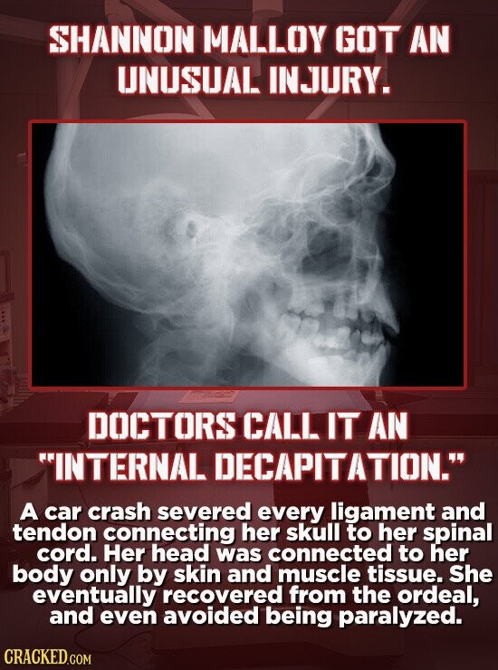 SHANNON MALLOY GOT AN UNUSUAL INJURY. DOCTORS CALL IT AN INTERNAL DECAPITATION. A car crash severed every ligament and tendon connecting her skull to her spinal cord. Her head was connected to her body only by skin and muscle tissue. She eventually recovered from the ordeal, and even avoided being paralyzed. CRACKED.COM