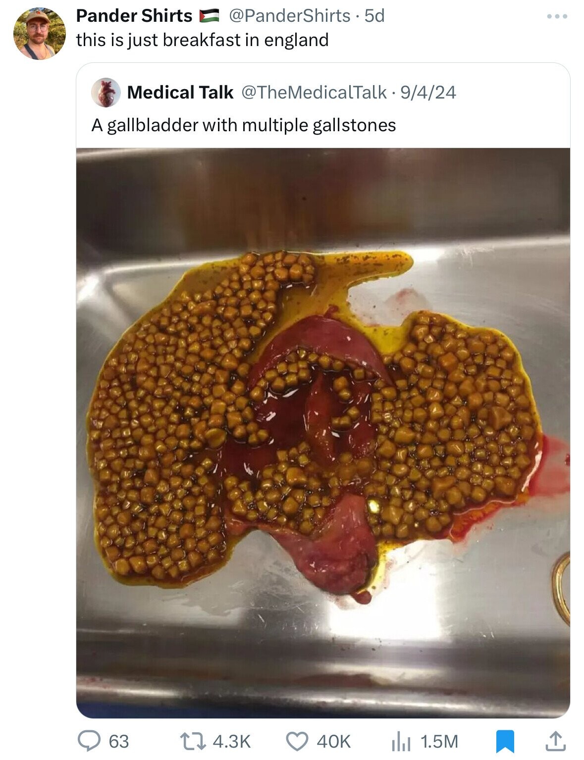 Pander Shirts @PanderShirts 5d this is just breakfast in england Medical Talk @TheMedicalTalk.9/4/24 A gallbladder with multiple gallstones 63 4.3K 40K 1.5M