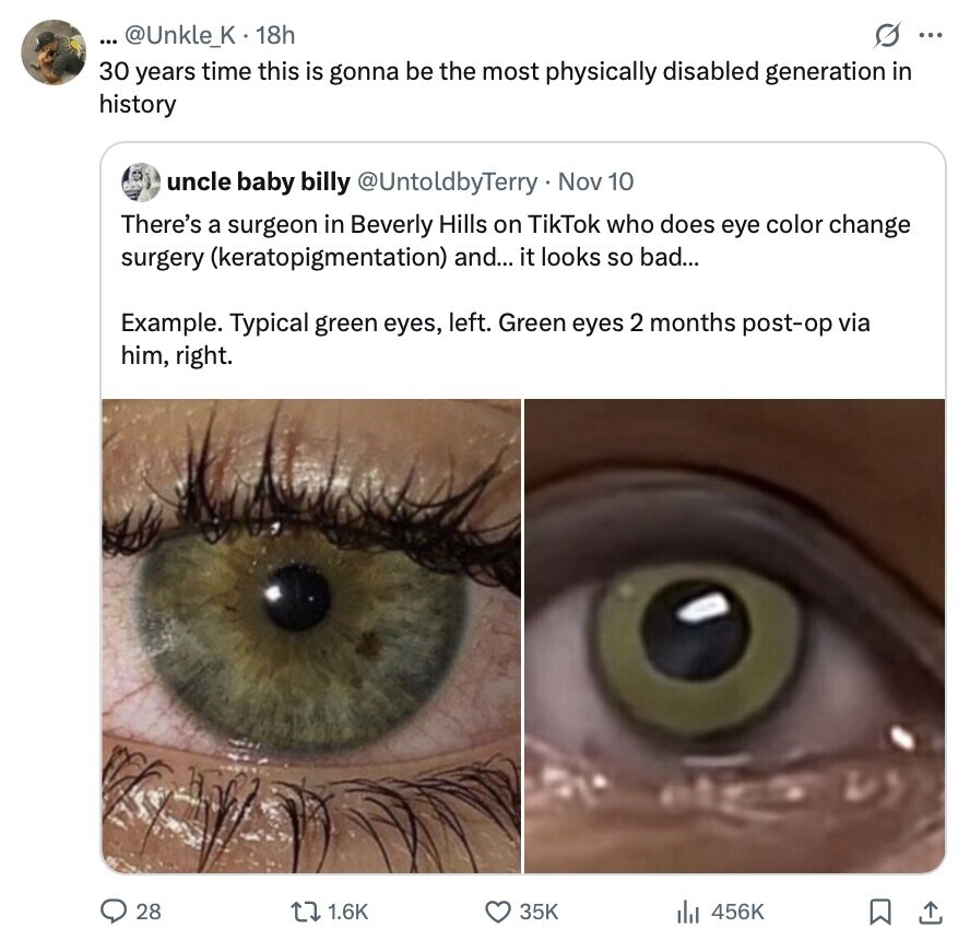 ... @Unkle_K . 1 18h S ... 30 years time this is gonna be the most physically disabled generation in history uncle baby billy @UntoldbyTerry Nov 10 There's a surgeon in Beverly Hills on TikTok who does eye color change surgery (keratopigmentation) and... it looks so bad... Example. Typical green eyes, left. Green eyes 2 months post-op via him, right. 28 1.6K 35K 456K 