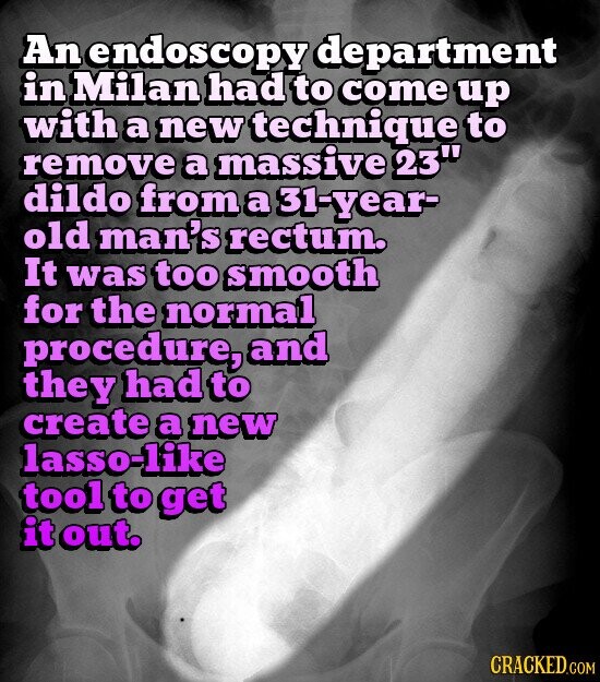An endoscopy department in Milan had to come up with a new technique to remove a massive 23 dildo from a 31-year- old man's rectum. It was too smooth for the normal procedure, and they had to create a new lasso-like tool to get it out. CRACKED.COM