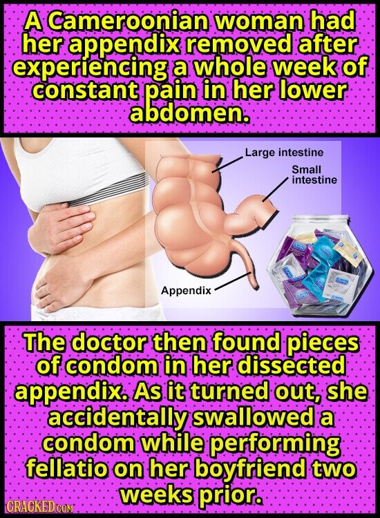 A Cameroonian woman had her appendix removed after experíencing a whole week of constant pain in her lower abdomen. Large intestine Small intestine STOP Appendix The doctor then found pieces of condom in her dissected appendix. As it turned out, she accidentally swallowed a condom while performing fellatio on her boyfriend two weeks prior. CRACKED COM