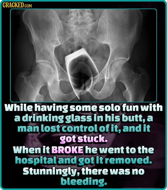 CRACKED.COM While having some solo fun with a drinking glass in his butt, a man lost control of it, and it got stuck. When it BROKE he went to the hospital and got it removed. Stunningly, there was no bleeding.
