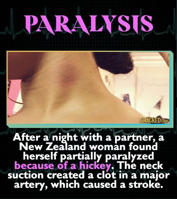 PARALYSIS CRACKED.COM After a night with a partner, a New Zealand woman found herself partially paralyzed because of a hickey. The neck suction created a clot in a major artery, which caused a stroke.