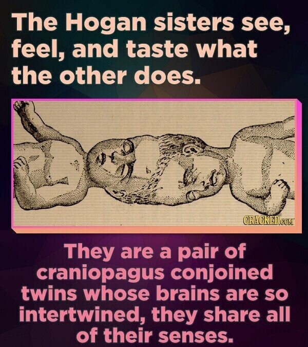 The Hogan sisters see, feel, and taste what the other does. CRACKED.COM They are a pair of craniopagus conjoined twins whose brains are SO intertwined, they share all of their senses.