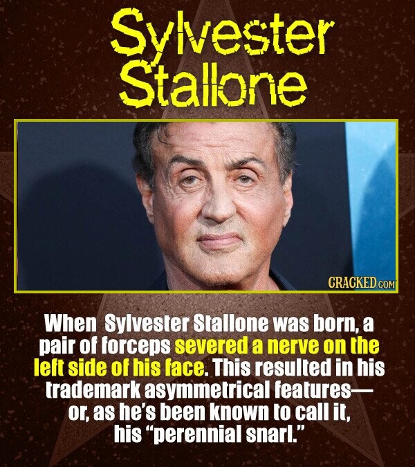 Syivester Stallone CRACKED cO When Sylvester Stallone was born, a pair of forceps severed a nerve on the left side of his face. This resulted in his t