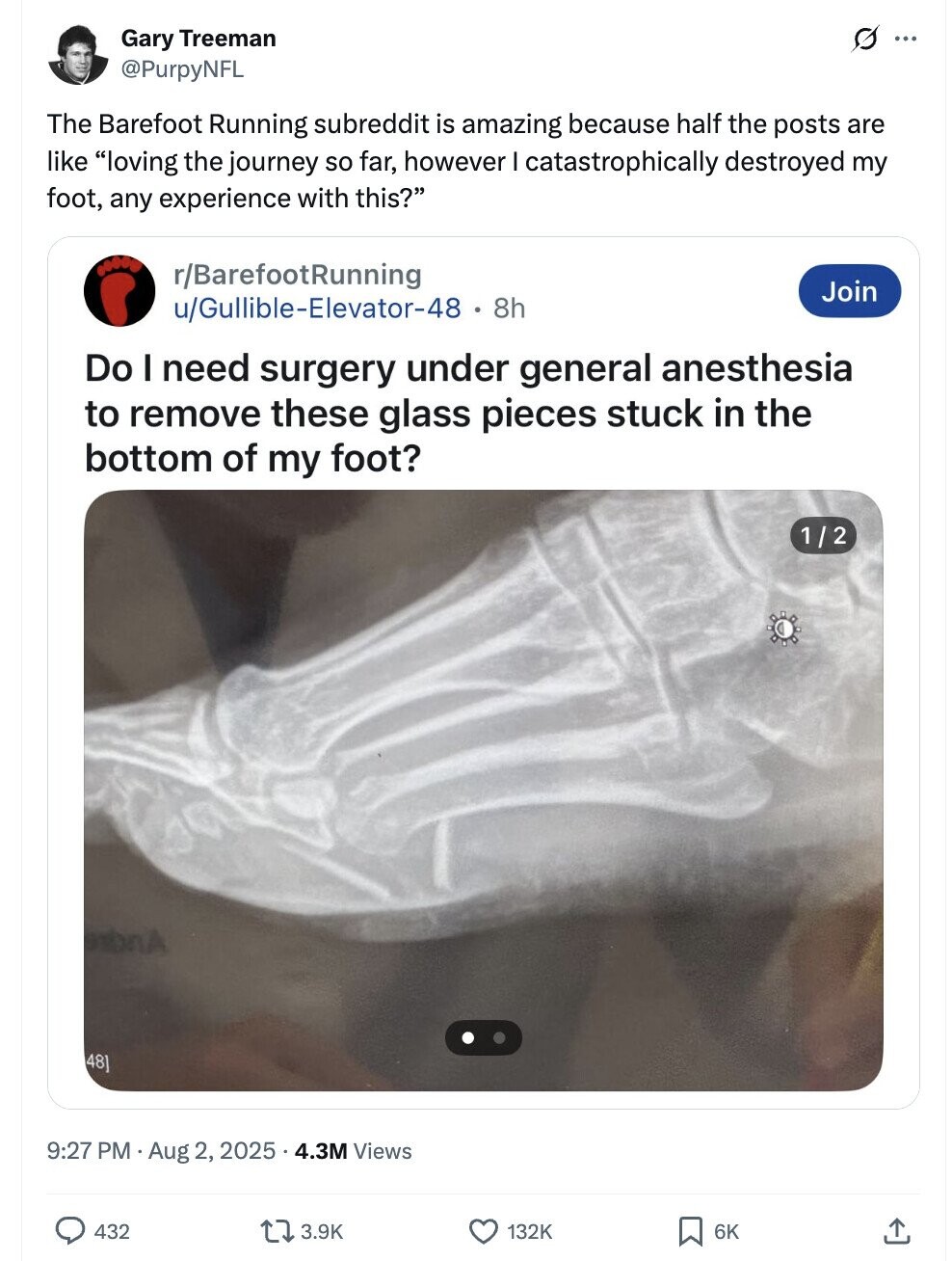G ... Gary Treeman @PurpyNFL The Barefoot Running subreddit is amazing because half the posts are like loving the journey so far, however I catastrophically destroyed my foot, any experience with this? r/BarefootRunning Join u/Gullible-Elevator-48 - : 8h Do I need surgery under general anesthesia to remove these glass pieces stuck in the bottom of my foot? 1/2 48] 9:27 PM Aug 2, 2025 4.3M Views 432 3.9K 132K 6K 