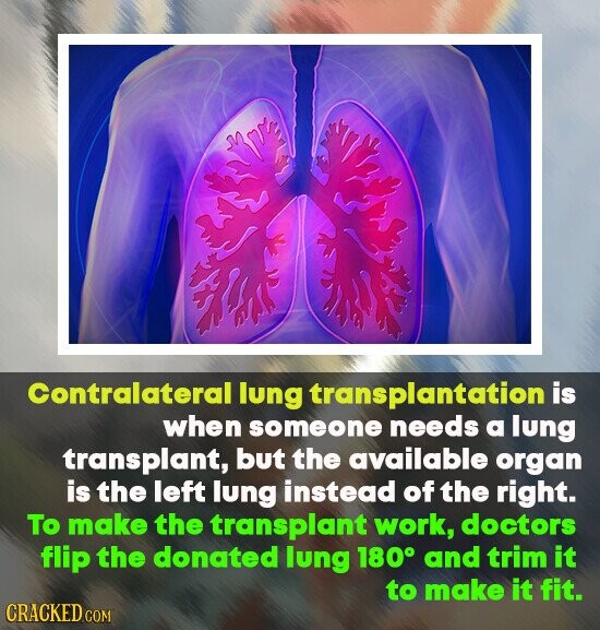 Contralateral lung transplantation is when someone needs a lung transplant, but the available organ is the left lung instead of the right. To make the transplant work, doctors flip the donated lung 180° and trim it to make it fit. CRACKED COM