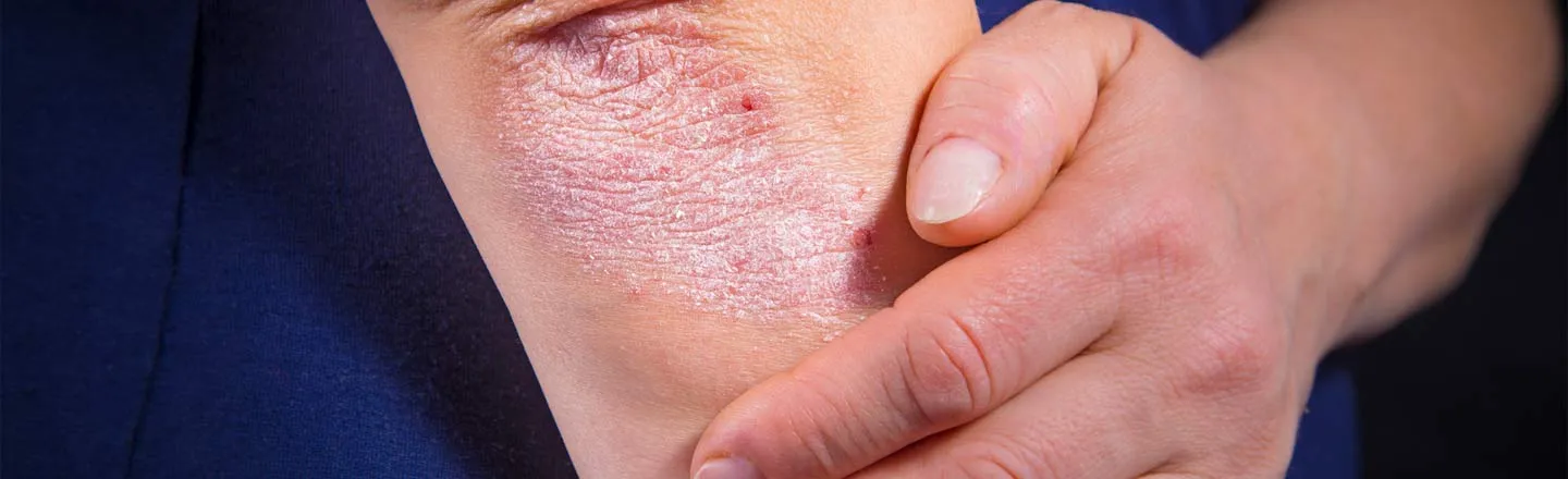 4 Ways Psoriasis Is Even More Heartbreaking Than You Thought