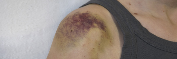 5 Things You Learn When Your Body Can't Stop Bleeding