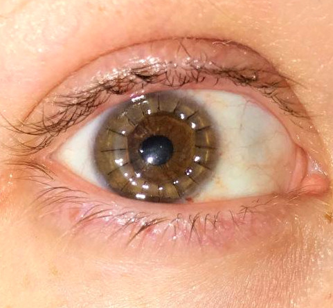How A Simple Contact Lens Mishap Can Destroy Your Eyeball