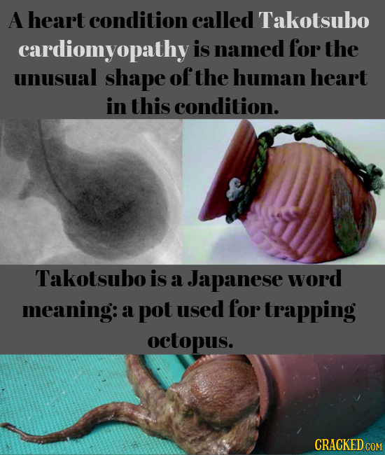 A heart condition called Takotsubo cardiomyopathyi is named for the unusual shape of the human heart in this condition. Takotsubo is a Japanese word m