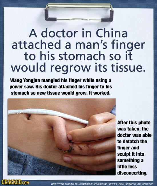 A doctor in China attached a man's finger to his stomach SO it would regrow its tissue. Wang Yongjun mangled his finger while using a power saw. His d