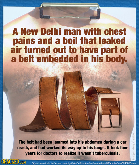 A New Delhi man with chest pains and a boil that leaked air turned out to have part of a belt embedded in his body. The belt had been jammed into his