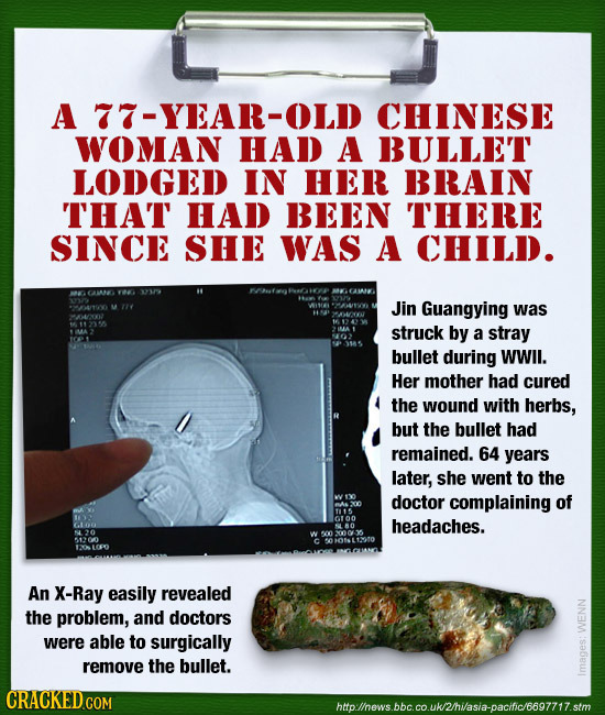 A 77-YEAR-OLD CHINESE WOMAN HAD A BULLET LODGED IN HER BRAIN THAT HAD BEEN THERE SINCE SHE WAS A CHILD. C14K 40100 M 121 Jin Guangying was WV 11136 st