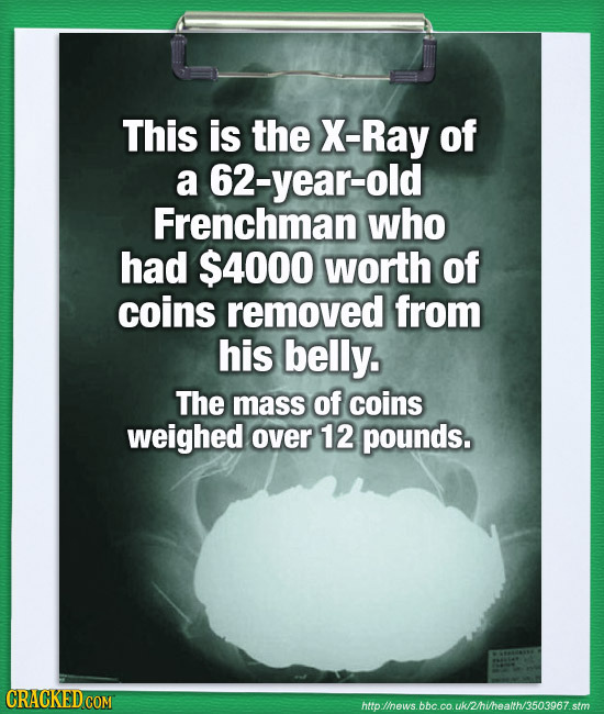 This is the X-Ray of a 62-year-old Frenchman who had $4000 worth of coins removed from his belly. The mass of COins weighed over 12 pounds. CRACKED CO
