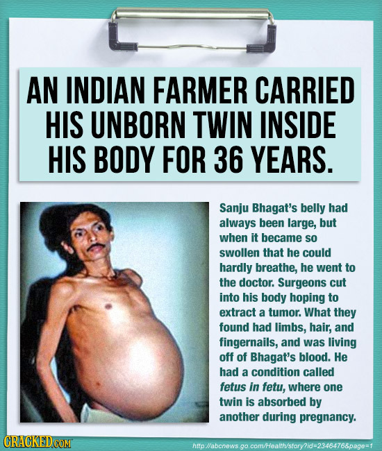 AN INDIAN FARMER CARRIED HIS UNBORN TWIN INSIDE HIS BODY FOR 36 YEARS. Sanju Bhagat's belly had always been large, but when it became so swollen that 