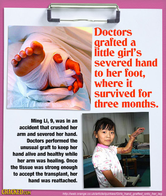 Doctors grafted a little girl's severed hand to her foot, where it survived for three months. Ming Li, 9, was in an accident that crushed her arm and