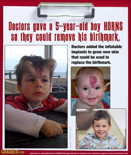 Doctors gave a 5-year-old boy HORNS SO they could remove his birthmark. Doctors added the inflatable implants to grow new skin that could be used to r