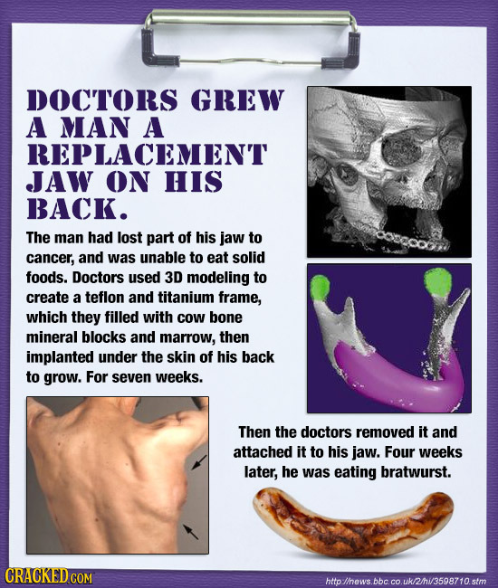 DOCTORS GREW A MAN A REPLACEMENT JAW ON hIS BACK. The man had lost part of his jaw to cancer, and was unable to eat solid foods. Doctors used 3D model