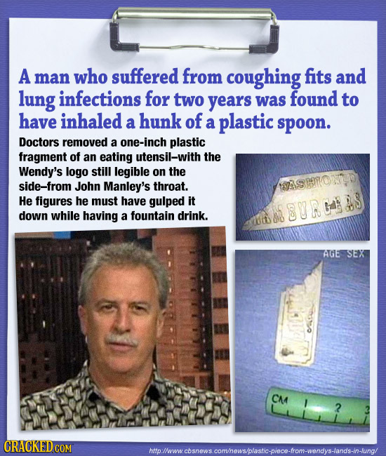 A man who suffered from coughing fits and lung infections for two years was found to have inhaled hunk of a a plastic spoon. Doctors removed a one-inc