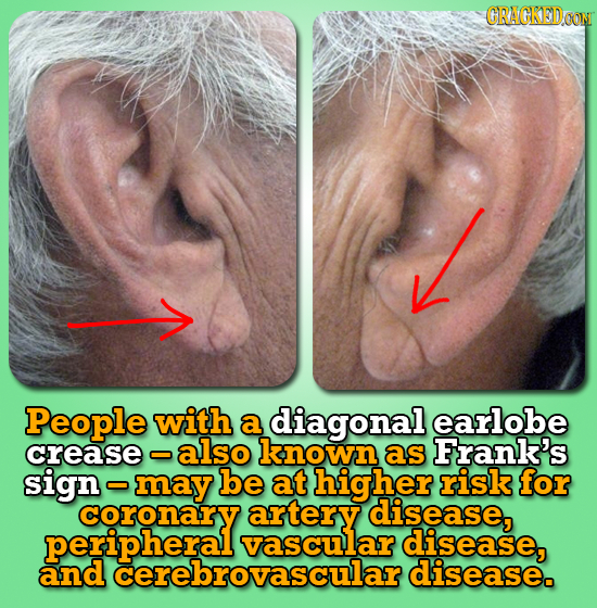 CRACKEDOON People with a diagonal earlobe crease also known as Frank's sign may be at higher risk for coronary artery disease, periphelarovascular vas