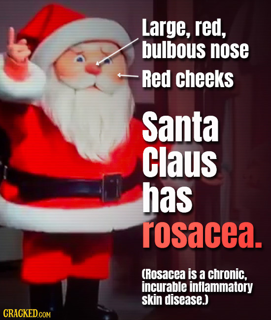 Large, red, bulbous nose -ReD cheeks Santa Claus has rosacea. (RosaceA is a chronic, incurable inflammatory skin disease.)
