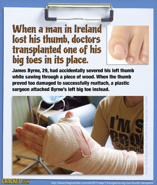 When a man in lreland lost his thumb, doctors transplanted one of his big toes in its place. James Byrne, 29, had accidentally severed his left thumb