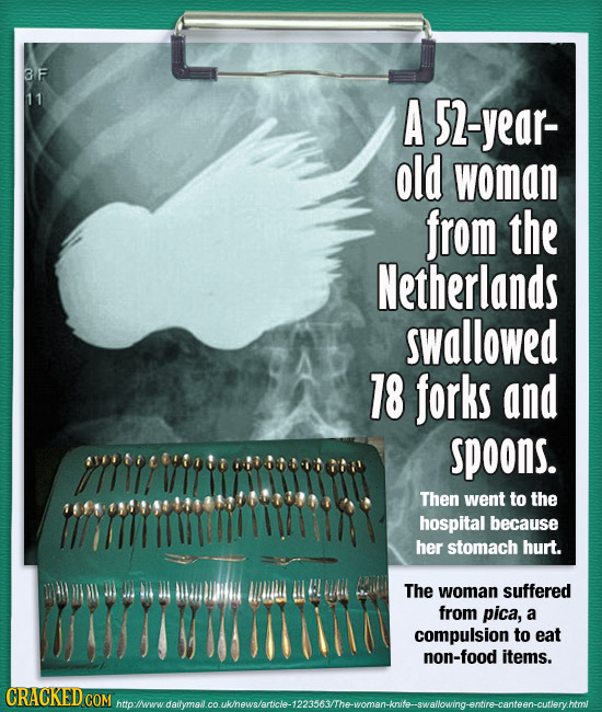 3F 11 A S2-year- old woman from the Netherlands swallowed 18 forks and spoons. mmeimmmin Then went to the hospital because her stomach hurt. A ll RLLI