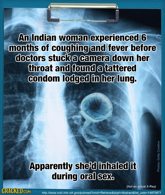 An Indian woman experienced 6 months of coughing and fever before doctors stuck a camera down her throat and found a tattered condom lodged in her lun