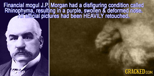 Financial mogul J.P. Morgan had a disfiguring condition called Rhinophyma, resulting in a purple, swolen & deformed nose. All official pictures had be