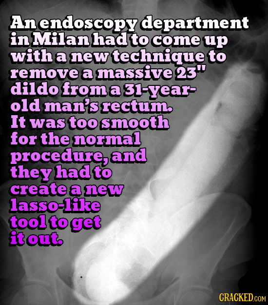 An endoscopy department in Milan had to come up with a new technique to remove a massive 23 dildo from a 31-year- old man's rectum. It was too smooth